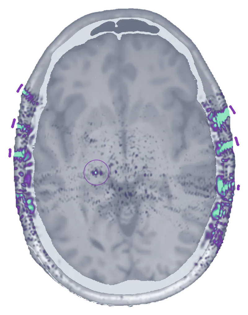 Axial brain slice showing ultrasound focused through the skull onto a deep target